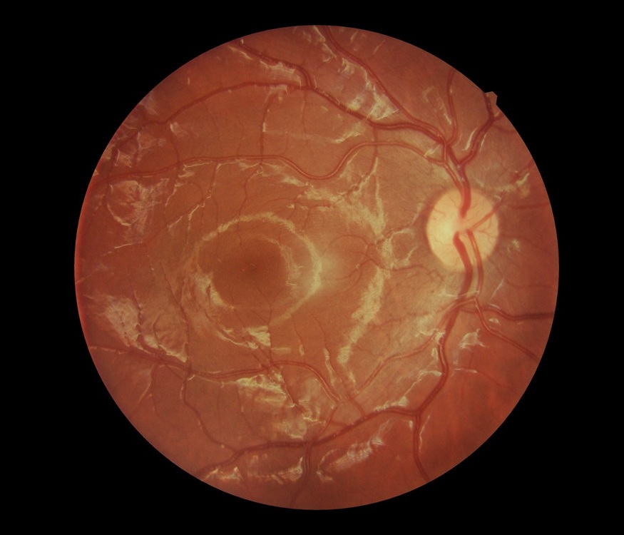 retino photo bouc bel air